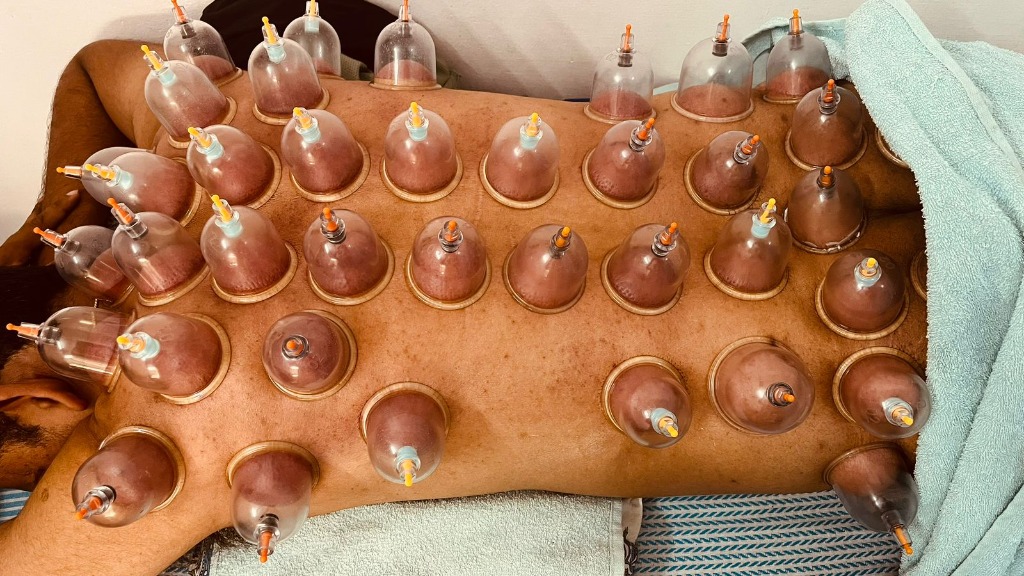 Advanced Cupping Therapy Treatment