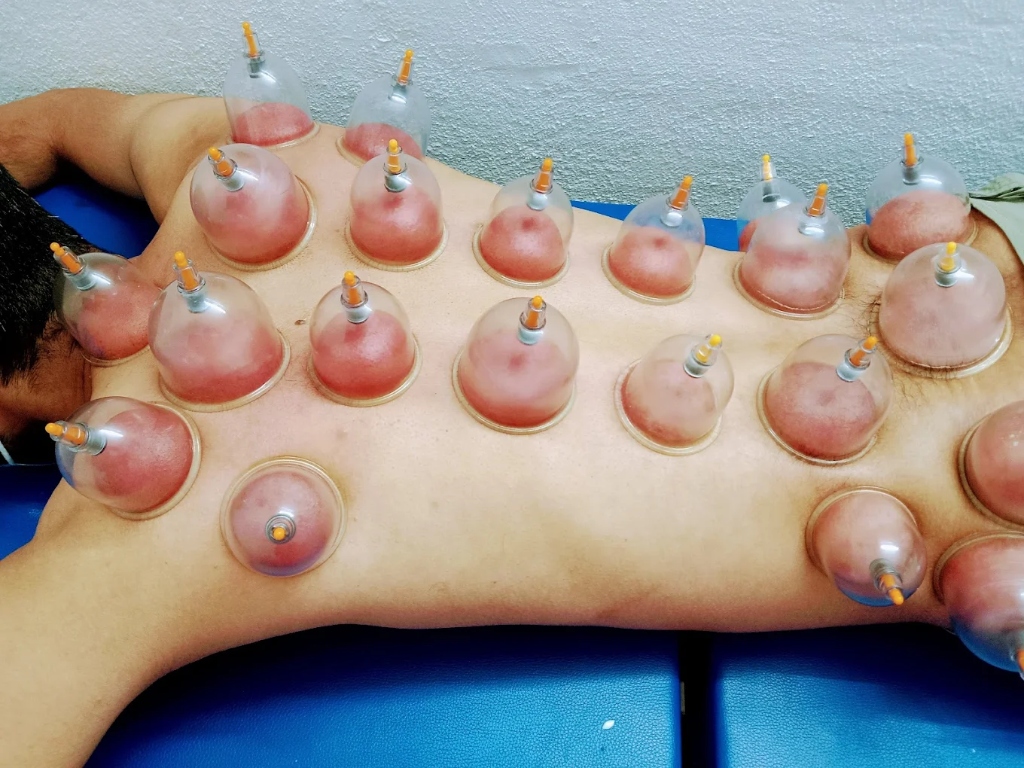 Advanced Cupping Therapy Session