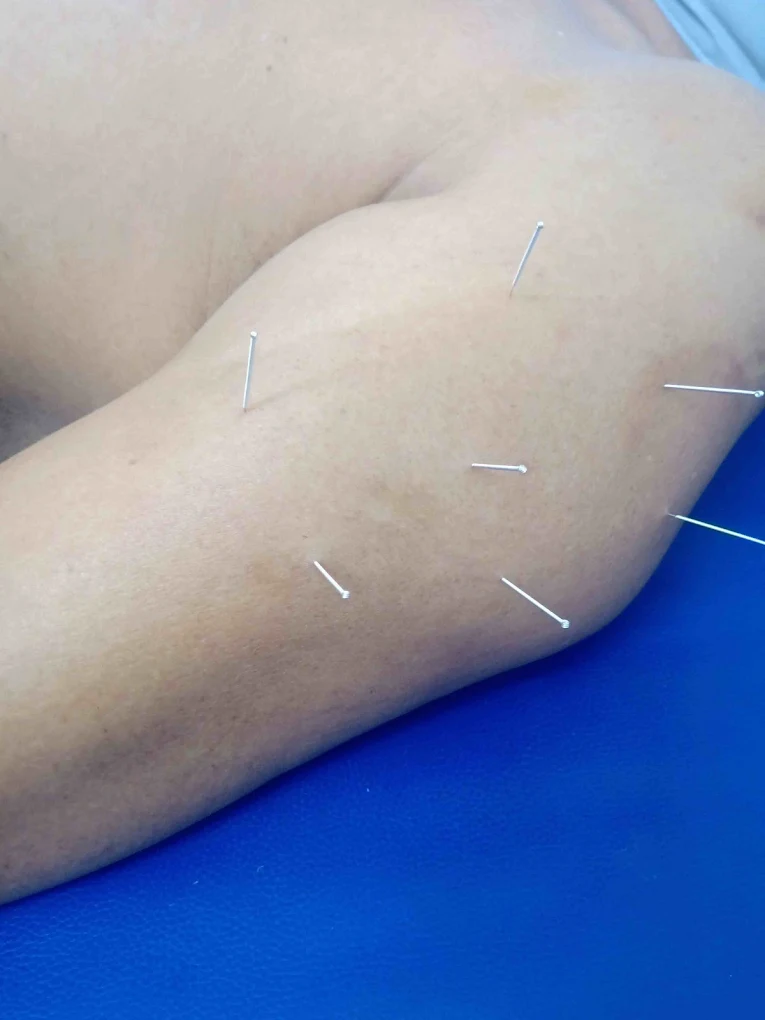 Dry Needling Therapy
